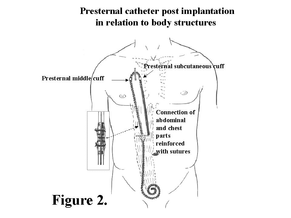 catheter dialysis peritoneal removal access twardowski conf uninet edu stencil wounds