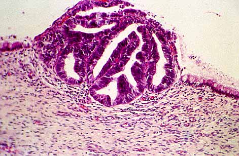 Implante endocervical