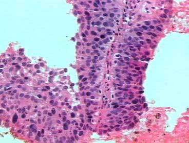 Biopsia de crvix x 200