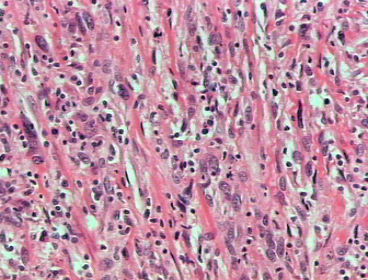 reas semejantes a un leiomiosarcoma x 200