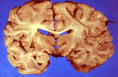 Cerebro. Infartos