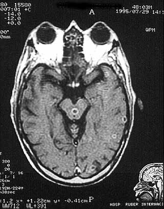 RNM cerebro y mesencfalo