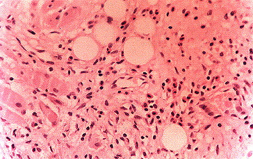 Fig. 2.- Biopsia de lengua