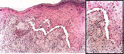 Fig 3.- PPN