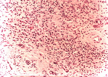 Fig. 1.- Pseudotumor Inflamatorio