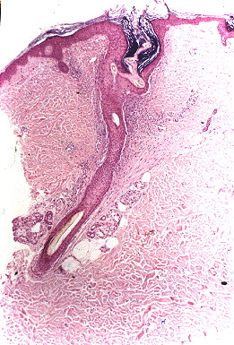 Fig. 3.- Escorbuto