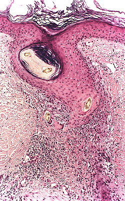 Fig. 4.- Escorbuto