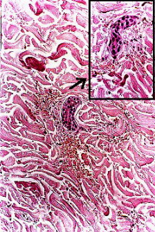 Fig. 5.- Escorbuto