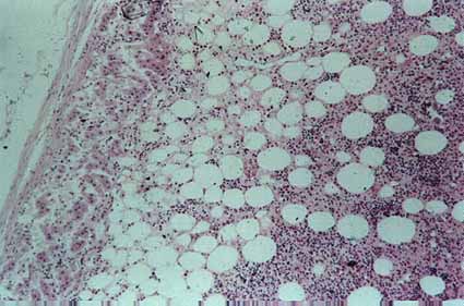 Myelolipoma, HE 100x