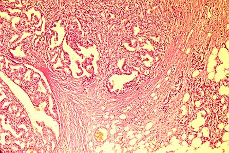 Fig. 22. ADENOCARCINOMA DE MAMA, HOT SPOT. 