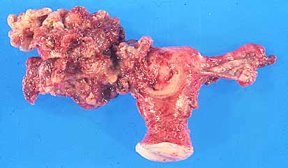 Fig. 23. CARCINOMA DE OVARIO