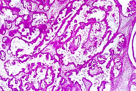 Fig. 28. CARCINOMA SEROSO ANEUPLOIDE 