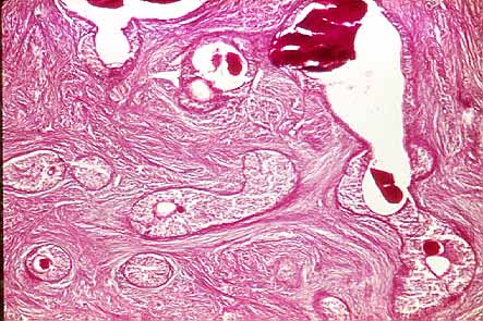 Fig. 32. TUMOR DE BRENNER