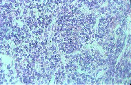 Fig. 35. TUMOR DE CELULAS PEQUEAS DEL OVARIO