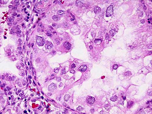 Biopsia de Endometrio - 400x