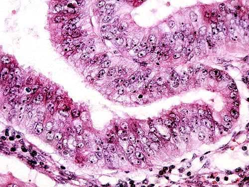 Biopsia de Endometrio - 400x