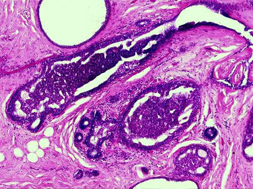 Biopsia de Mama - 100x