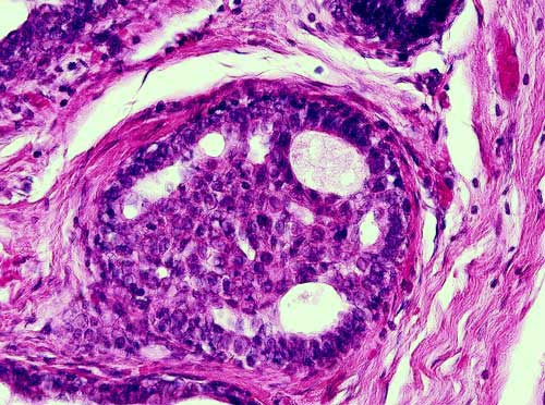 Biopsia de Mama - 400x