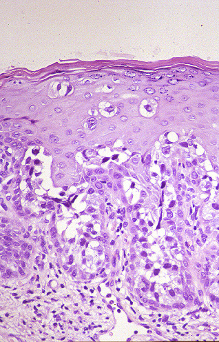 Imagen de CARCINOMA UROTELIAL IN SITU DETECTADO POR DISEMINACIÓN PAGETOIDE EN PENE
