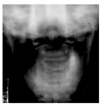 Tomografa lineal de C2 en proyeccin AP.