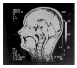 Angulacin bulbomedular por compresin de la apfisis odontoides.