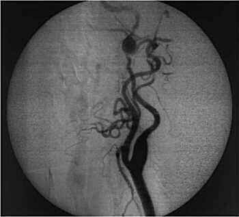 Angiografa convencional.