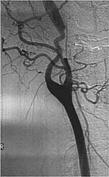 Angiografa convencional.