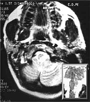 RM (T2); corte axial.