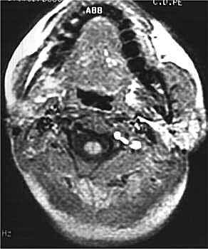 RM (T1); corte axial.