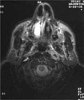 Hematoma pericarotdeo izquierdo.