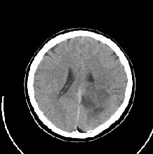 glioma5.jpg (12808 bytes)