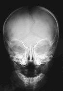 Fractura lineal en regin parietal izquierda