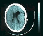 Imagen residual postoperaoria en TAC