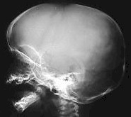 Fractura lineal en regin parietal izquierda