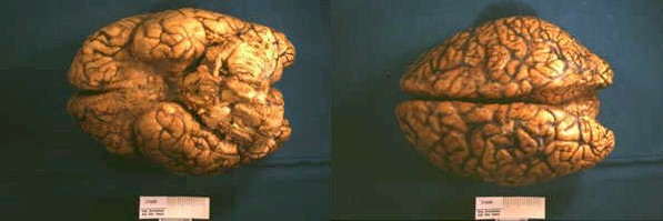 Engrosamiento y opacificacin de las leptomeninges.