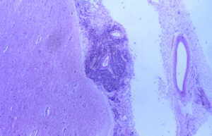 Proliferacin neoplsica difusa.