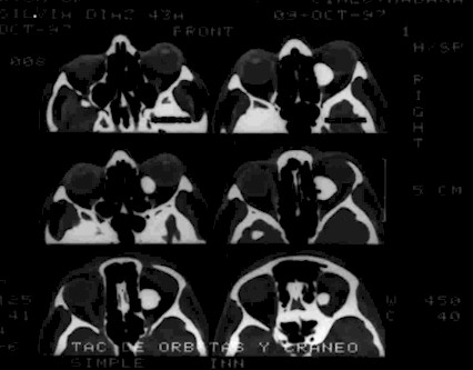 Tomografa axial de crneo y rbita