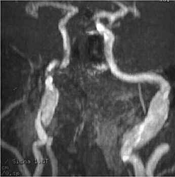 Angio-RM; tpica imagen de displasia fibromuscular en ambas cartidas. 