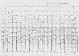 Pulse sobre el ECG para ver una imagen ampliada (94K)